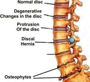 spinal osteochondrosis)