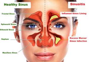 sinusitis 1 1 Almagia
