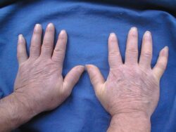 treatment for scleroderma